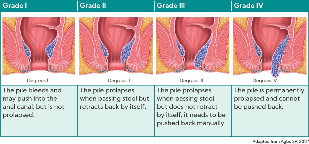 Foods to help ease Piles (haemorrhoids) and IBS - Smiles No Piles