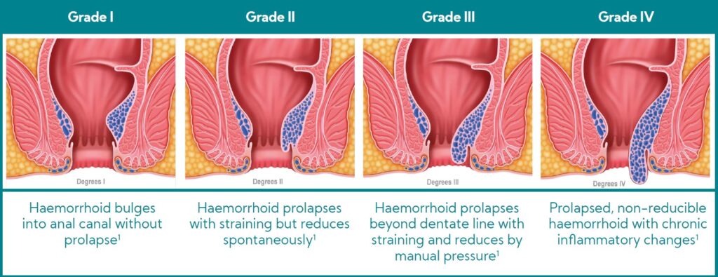 Internal haemorrhoids grading