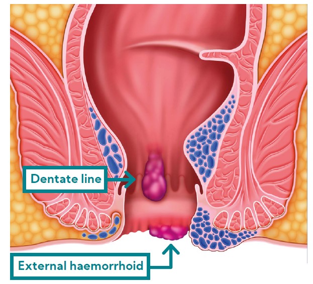 Internal and external haemorrhoids