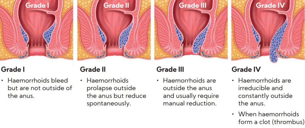 Internal haemorrhoids Grading