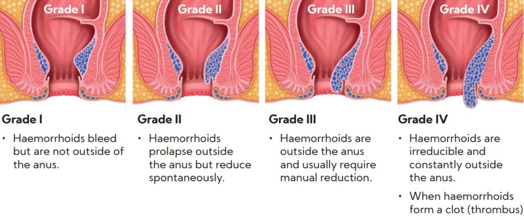 Experiencing That Painful Itchy Feeling Smiles No Piles   Internal Haemorrhoids Grading 1024x430 